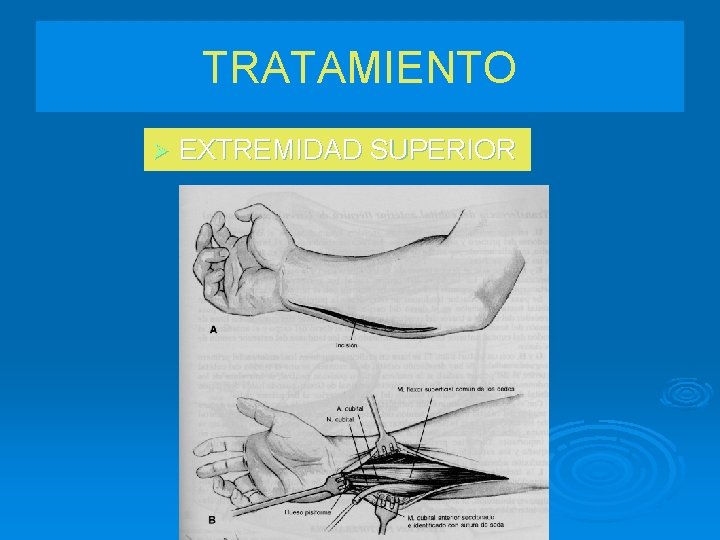 TRATAMIENTO Ø EXTREMIDAD SUPERIOR 