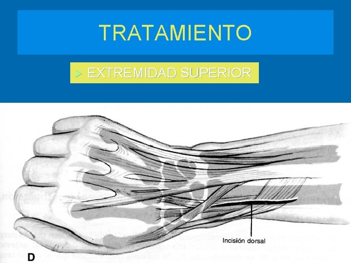 TRATAMIENTO Ø EXTREMIDAD SUPERIOR 