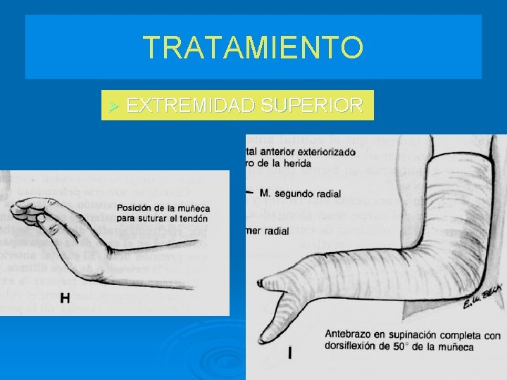 TRATAMIENTO Ø EXTREMIDAD SUPERIOR 