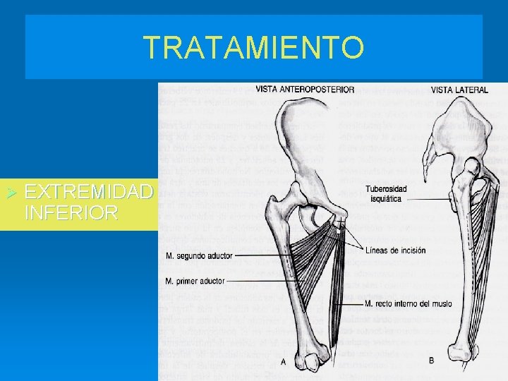 TRATAMIENTO Ø EXTREMIDAD INFERIOR 