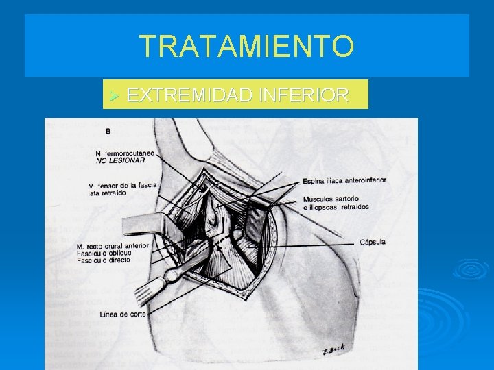 TRATAMIENTO Ø EXTREMIDAD INFERIOR 