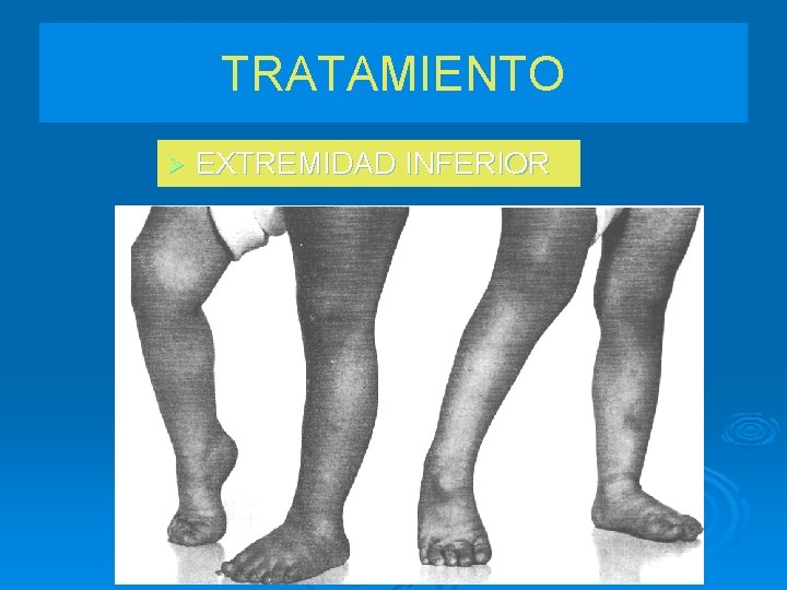 TRATAMIENTO Ø EXTREMIDAD INFERIOR 