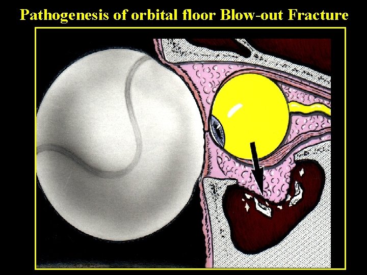 Pathogenesis of orbital floor Blow-out Fracture 