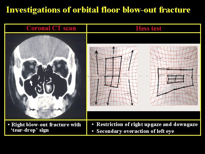 Investigations of orbital floor blow-out fracture Coronal CT scan • Right blow-out fracture with