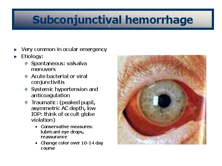 Subconjunctival hemorrhage Very common in ocular emergency Etiology: Spontaneous: valsalva menuvers Acute bacterial or