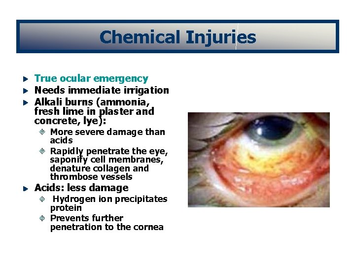 Chemical Injuries True ocular emergency Needs immediate irrigation Alkali burns (ammonia, fresh lime in