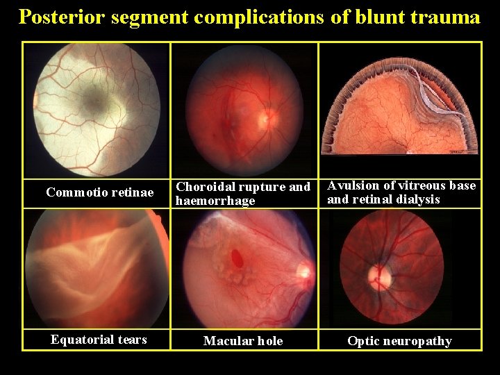 Posterior segment complications of blunt trauma Commotio retinae Choroidal rupture and haemorrhage Avulsion of