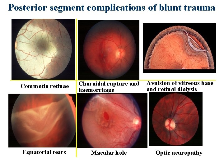 Posterior segment complications of blunt trauma Commotio retinae Choroidal rupture and haemorrhage Avulsion of