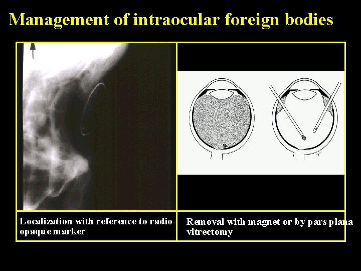 Management of intraocular foreign bodies Localization with reference to radioopaque marker Removal with magnet