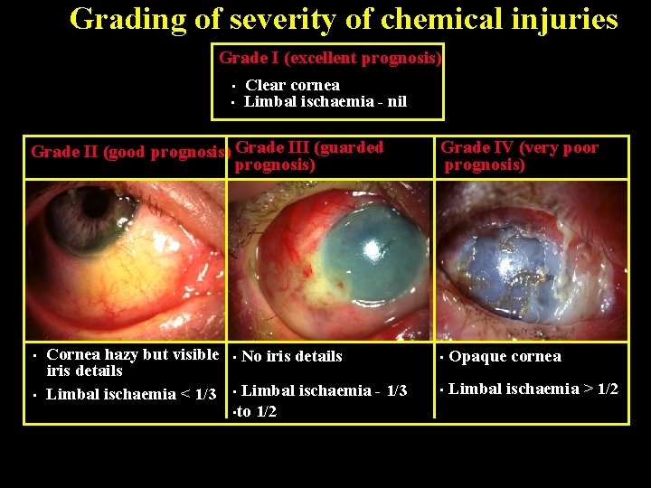 Grading of severity of chemical injuries Grade I (excellent prognosis) • • Clear cornea