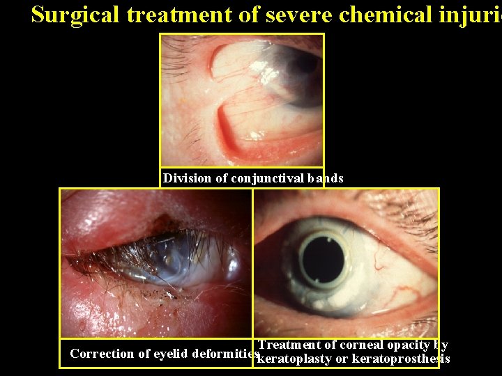 Surgical treatment of severe chemical injurie Division of conjunctival bands Treatment of corneal opacity