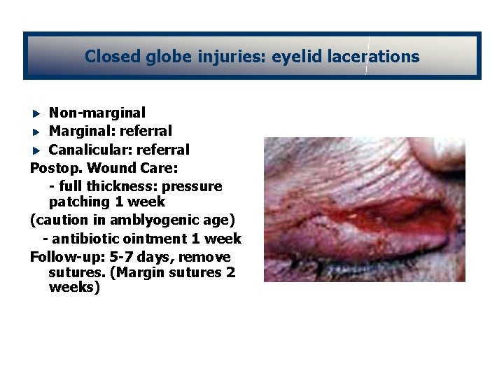 Closed globe injuries: eyelid lacerations Non-marginal Marginal: referral Canalicular: referral Postop. Wound Care: -