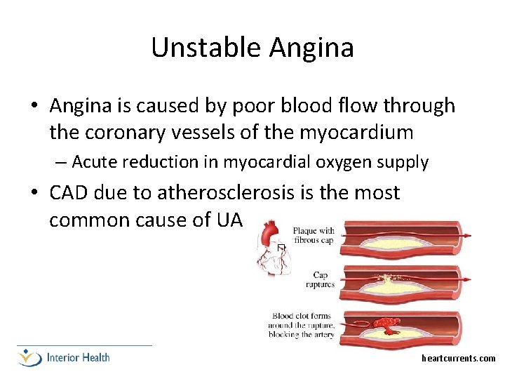 Unstable Angina • Angina is caused by poor blood flow through the coronary vessels