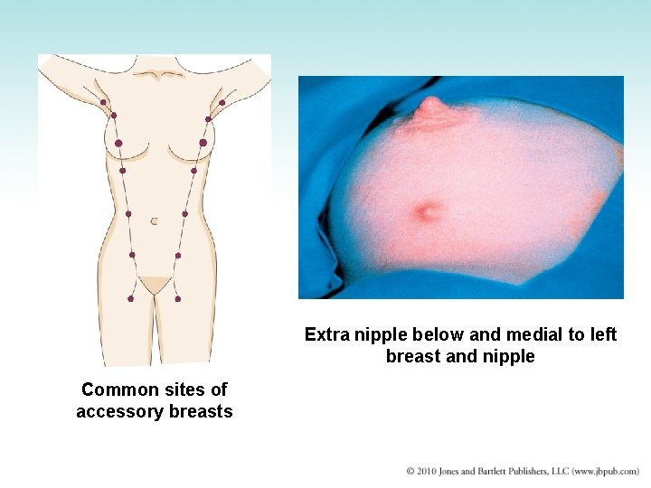 Extra nipple below and medial to left breast and nipple Common sites of accessory