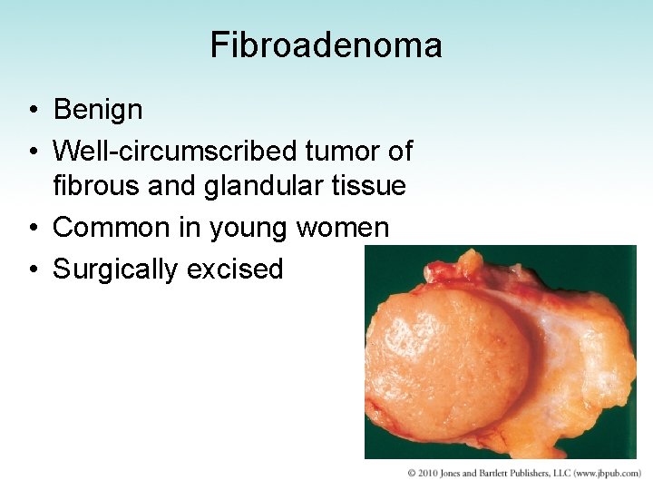 Fibroadenoma • Benign • Well-circumscribed tumor of fibrous and glandular tissue • Common in