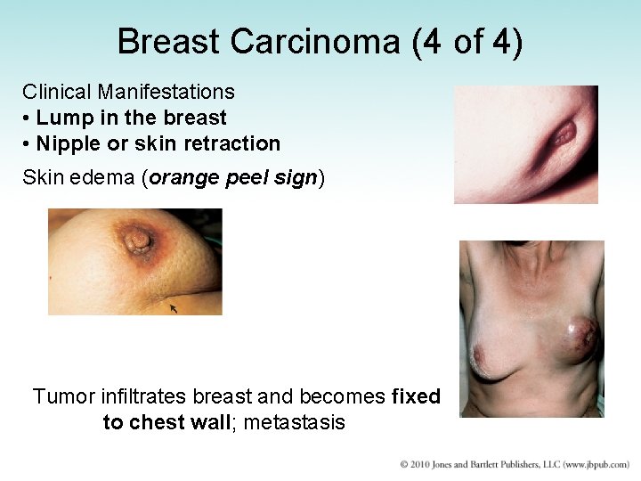 Breast Carcinoma (4 of 4) Clinical Manifestations • Lump in the breast • Nipple