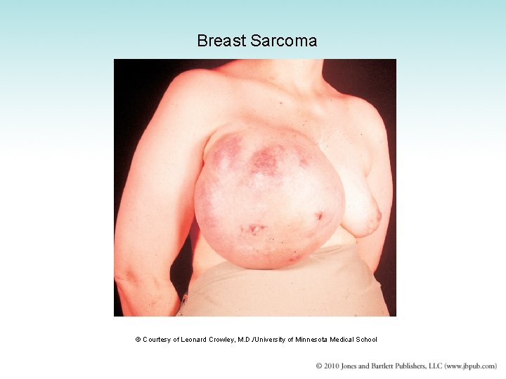 Breast Sarcoma © Courtesy of Leonard Crowley, M. D. /University of Minnesota Medical School