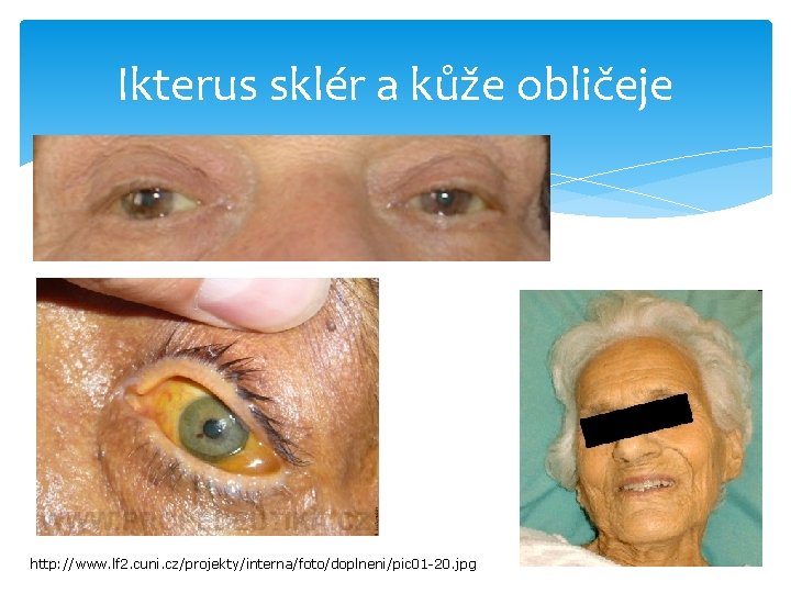 Ikterus sklér a kůže obličeje http: //www. lf 2. cuni. cz/projekty/interna/foto/doplneni/pic 01 -20. jpg