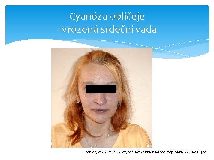 Cyanóza obličeje - vrozená srdeční vada http: //www. lf 2. cuni. cz/projekty/interna/foto/doplneni/pic 01 -20.