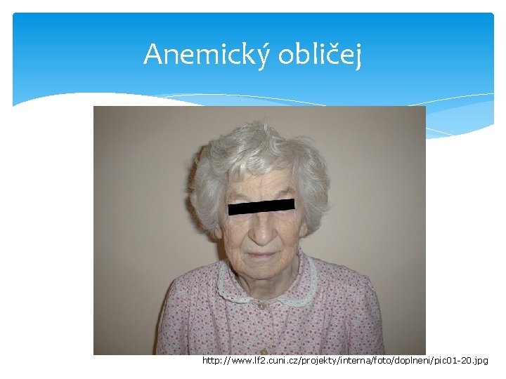 Anemický obličej http: //www. lf 2. cuni. cz/projekty/interna/foto/doplneni/pic 01 -20. jpg 