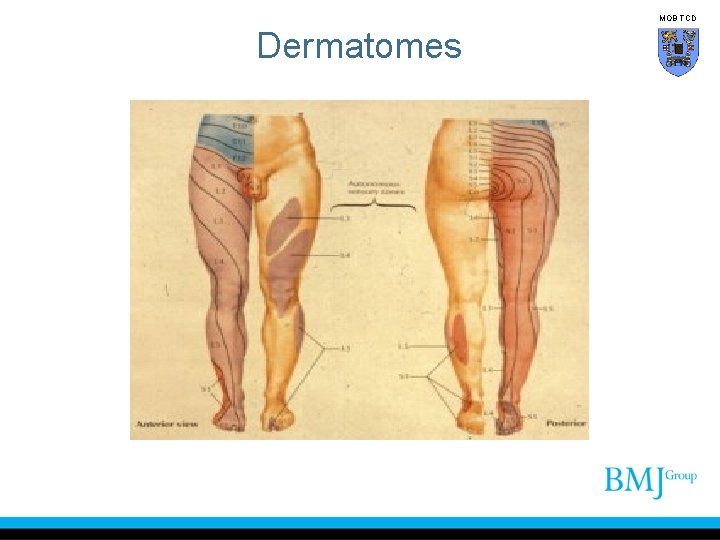 MOB TCD Dermatomes 