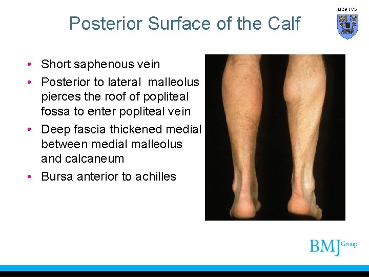 MOB TCD Posterior Surface of the Calf • Short saphenous vein • Posterior to
