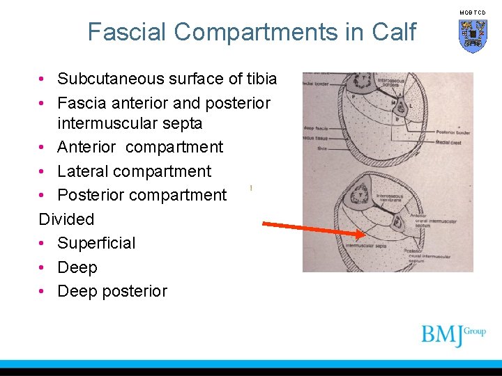 MOB TCD Fascial Compartments in Calf • Subcutaneous surface of tibia • Fascia anterior