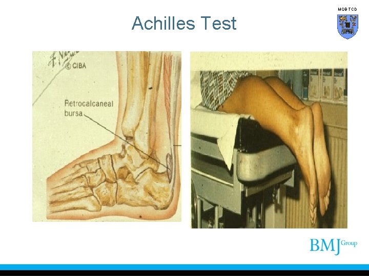 MOB TCD Achilles Test 