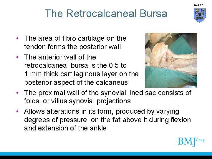 MOB TCD The Retrocalcaneal Bursa • The area of fibro cartilage on the tendon