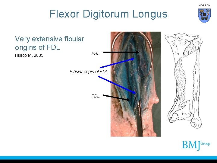 MOB TCD Flexor Digitorum Longus Very extensive fibular origins of FDL Hislop M, 2003
