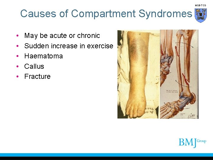 MOB TCD Causes of Compartment Syndromes • • • May be acute or chronic