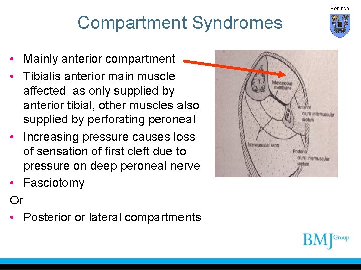 MOB TCD Compartment Syndromes • Mainly anterior compartment • Tibialis anterior main muscle affected
