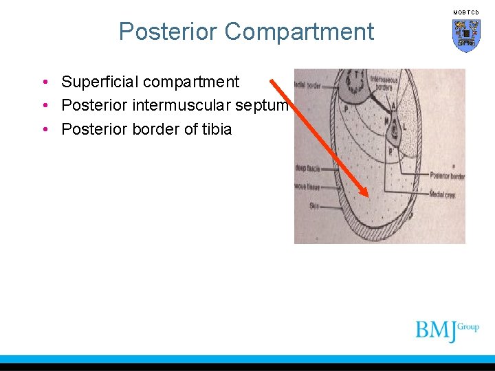 MOB TCD Posterior Compartment • Superficial compartment • Posterior intermuscular septum • Posterior border