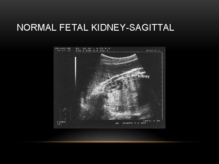 NORMAL FETAL KIDNEY-SAGITTAL 