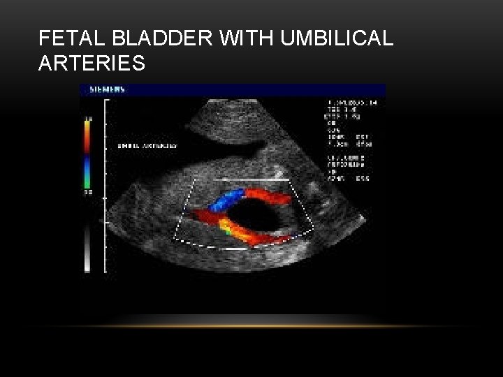 FETAL BLADDER WITH UMBILICAL ARTERIES 