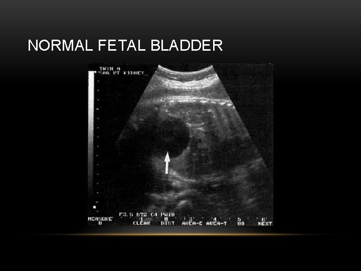 NORMAL FETAL BLADDER 