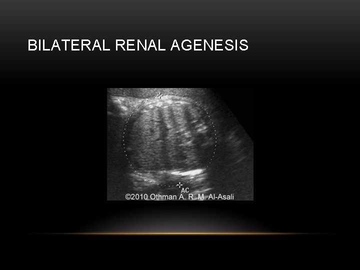 BILATERAL RENAL AGENESIS 