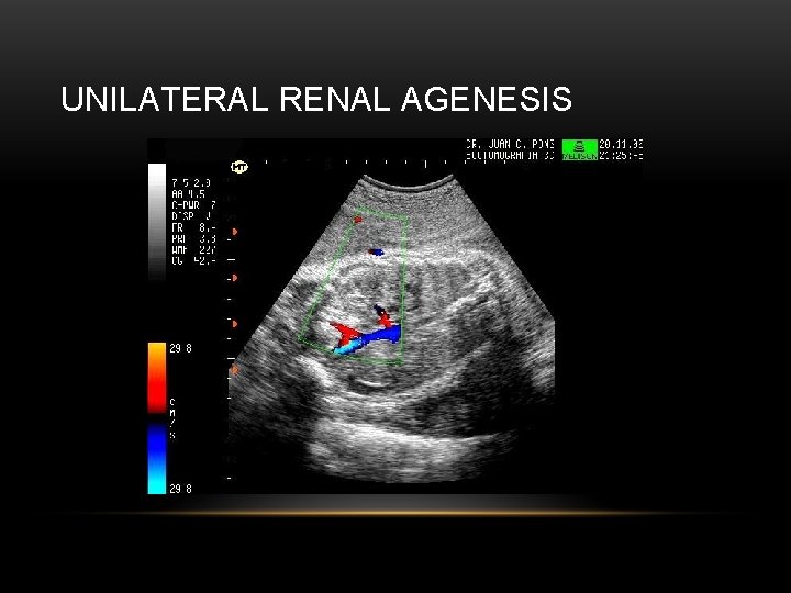 UNILATERAL RENAL AGENESIS 