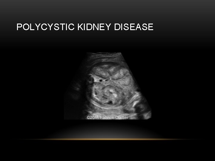 POLYCYSTIC KIDNEY DISEASE 