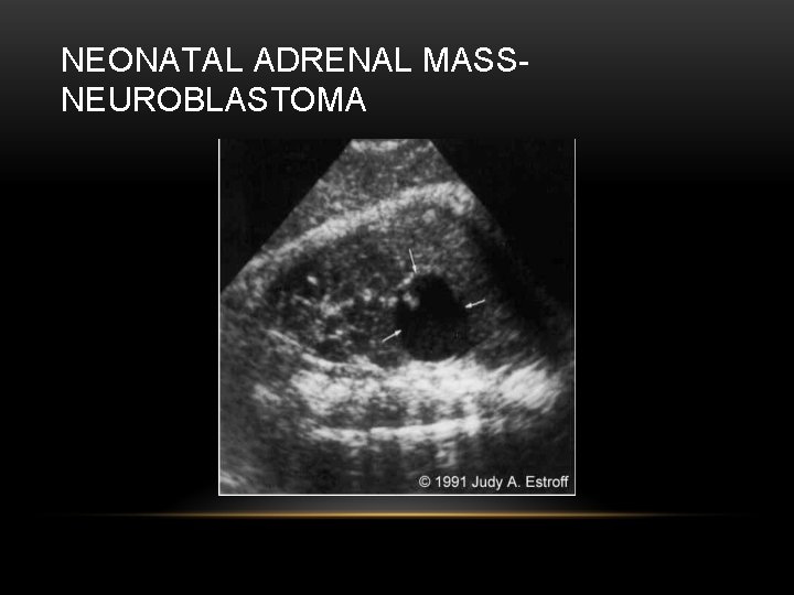 NEONATAL ADRENAL MASSNEUROBLASTOMA 
