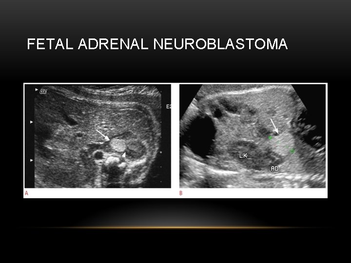 FETAL ADRENAL NEUROBLASTOMA 