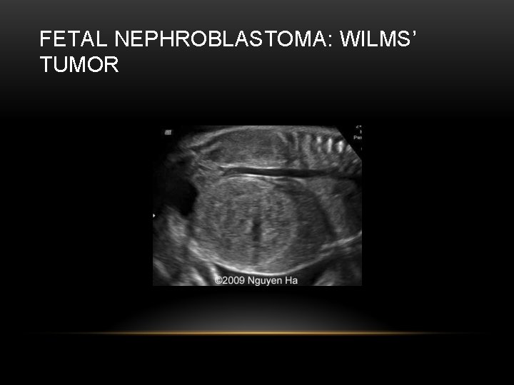 FETAL NEPHROBLASTOMA: WILMS’ TUMOR 