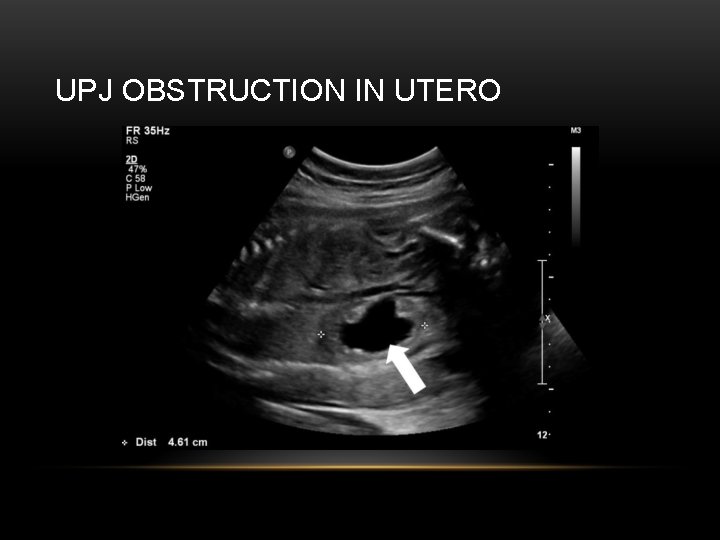 UPJ OBSTRUCTION IN UTERO 
