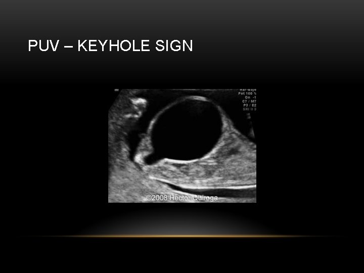 PUV – KEYHOLE SIGN 