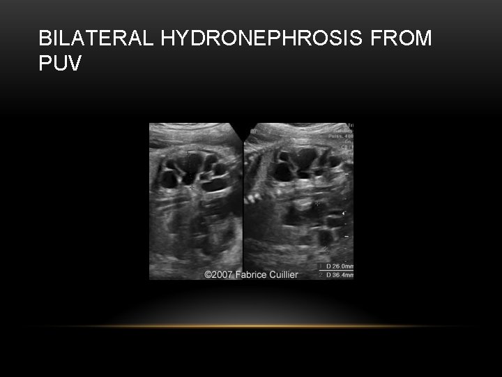 BILATERAL HYDRONEPHROSIS FROM PUV 