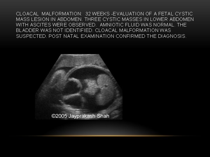 CLOACAL MALFORMATION: 32 WEEKS -EVALUATION OF A FETAL CYSTIC MASS LESION IN ABDOMEN. THREE