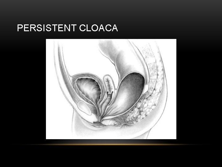 PERSISTENT CLOACA 
