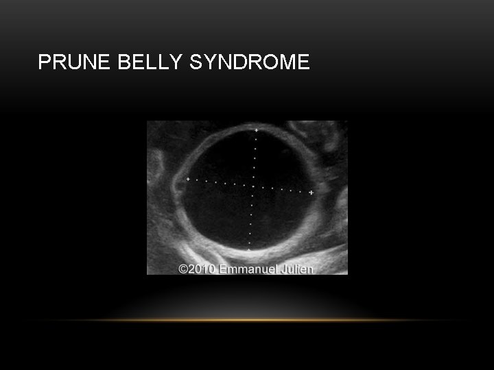 PRUNE BELLY SYNDROME 