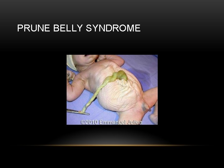 PRUNE BELLY SYNDROME 