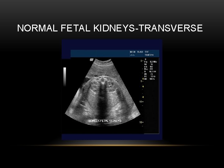 NORMAL FETAL KIDNEYS-TRANSVERSE 